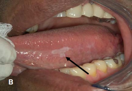 Hillside Dental Oral Connection To HPV   Oral Cancer To HPV Photo 